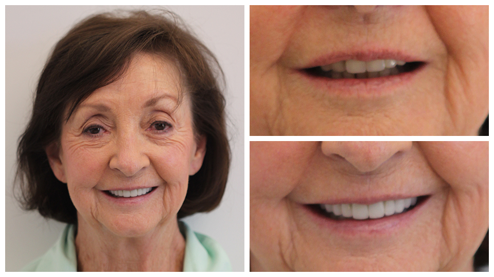 Patient of G. Graber DDS - Before and after dental work