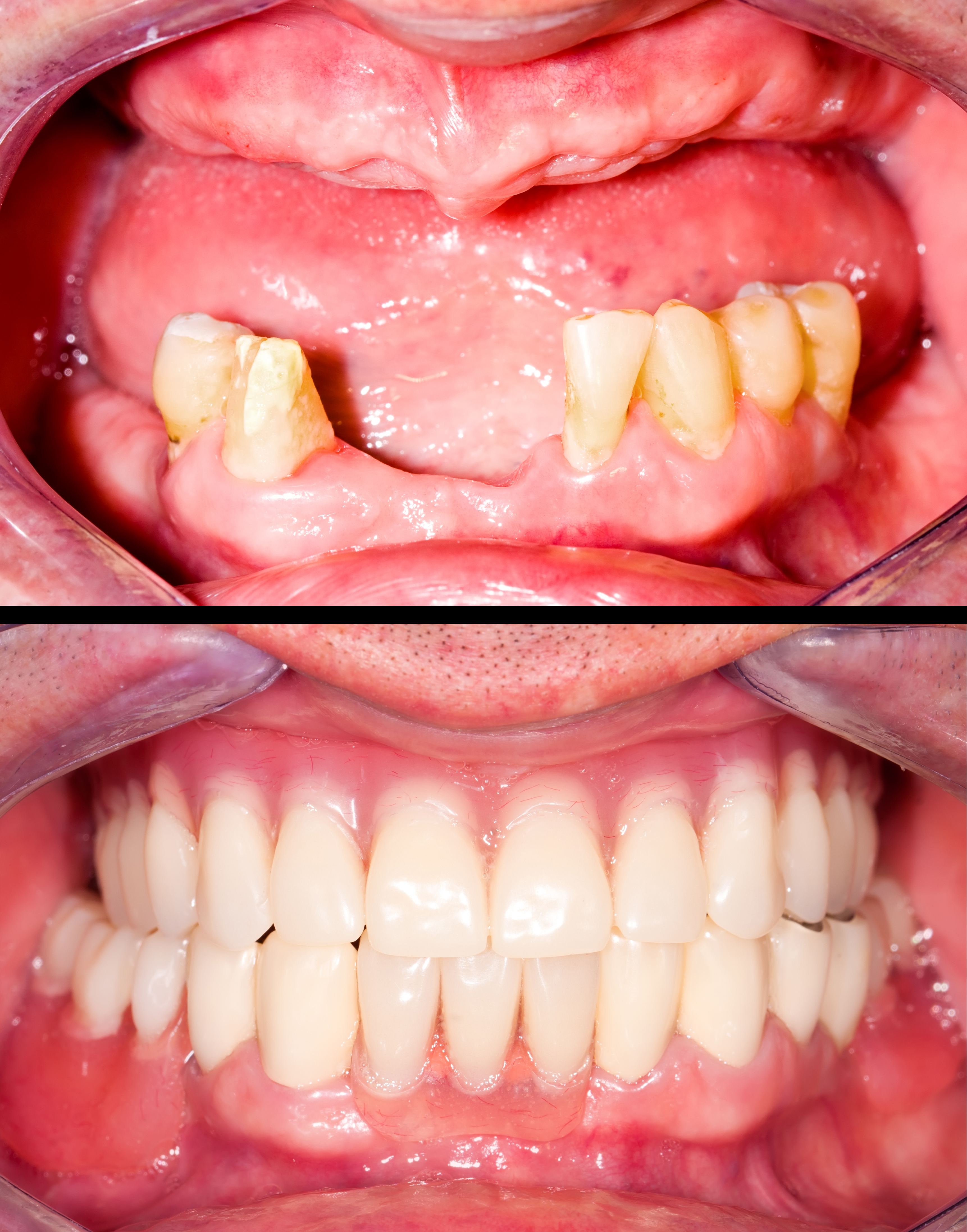 Before and after smile makeover photo