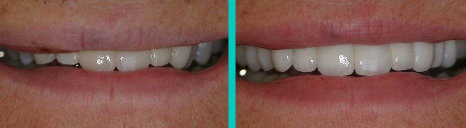 G. Graber DDS Patient before and after photos of dental work
