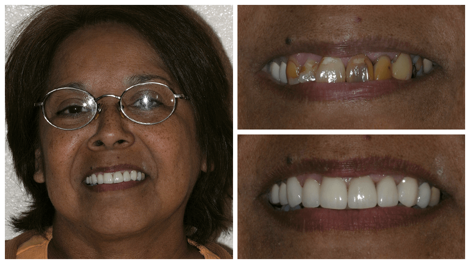 Patient of G. Graber DDS - Before and after dental work